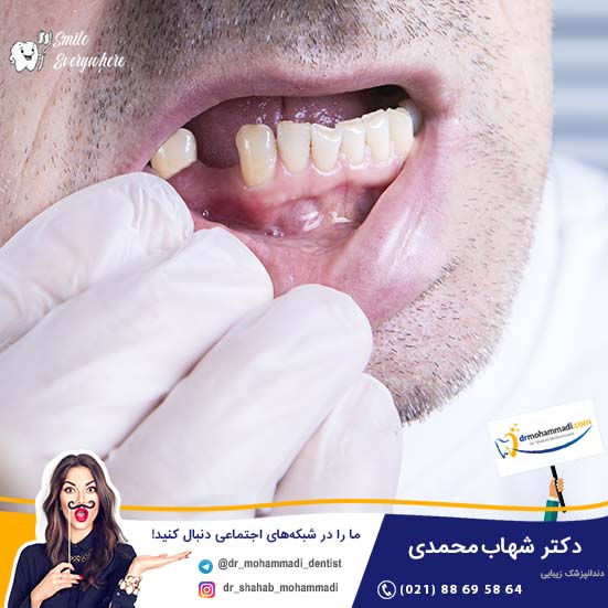 مشکلات و عواقب از دست دادن دندان و قرار ندادن ایمپلنت - کلینیک دندانپزشکی دکتر شهاب محمدی